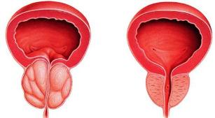 the difference of a sick and a healthy prostate