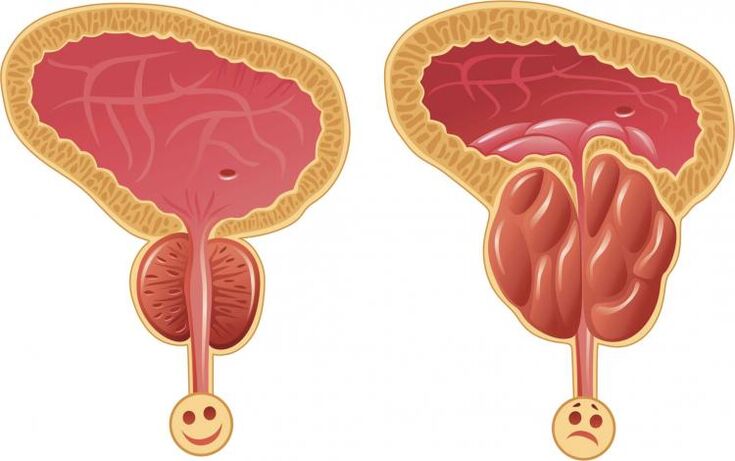 Healthy prostate and prostatitis